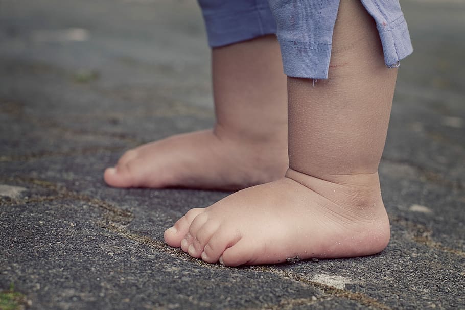 Apa Itu Lipedema? Bagaimana Ia Boleh Berlaku?