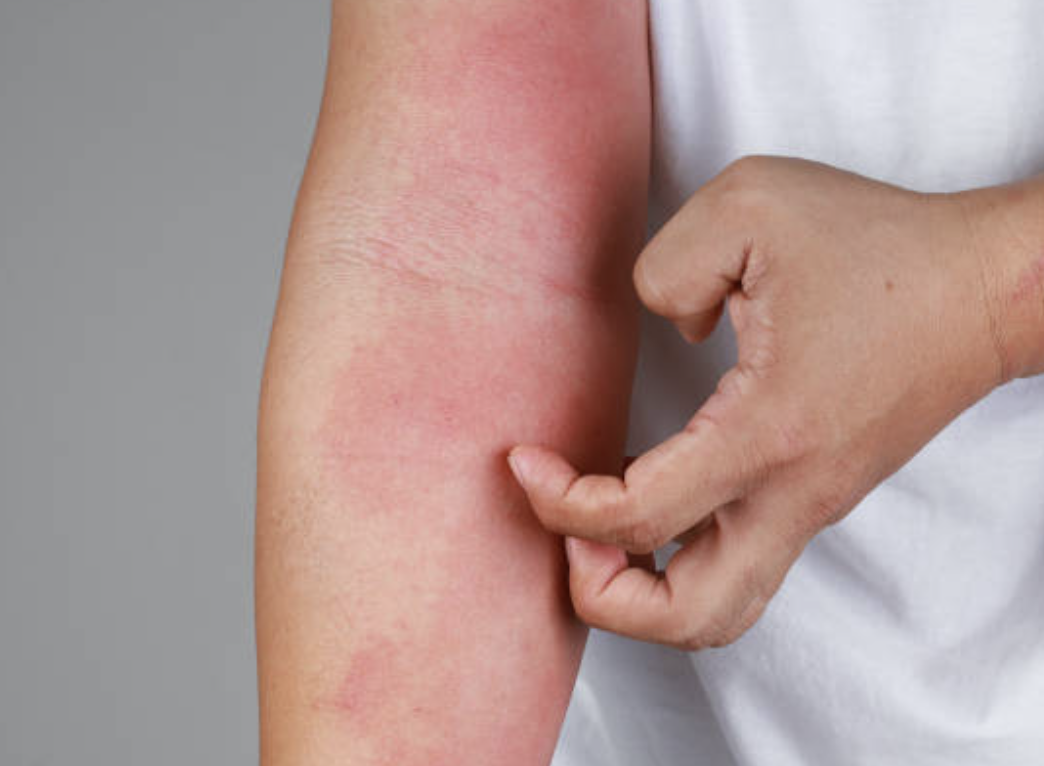 Psoriasis, Ekzema, Dermatitis: Apakah Perbezaannya?